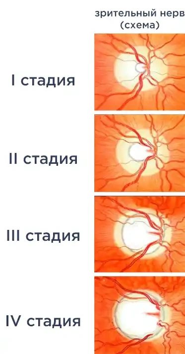 Глаукома: изображение по теме статьи