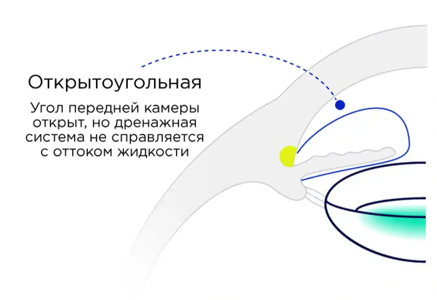 Лазерное лечение глаукомы: лечение