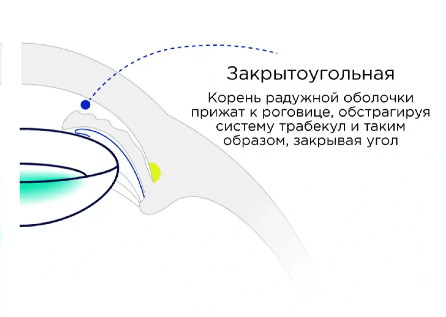 Лазерное лечение глаукомы: лечение