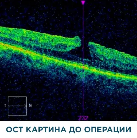 Макулярный разрыв: диагностика