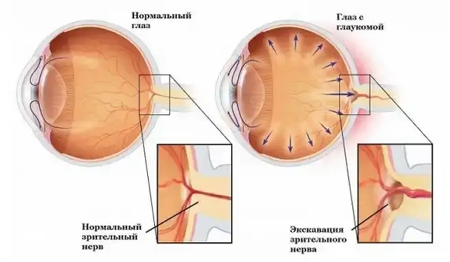 НГСЭ при глаукоме: иллюстрация к статье