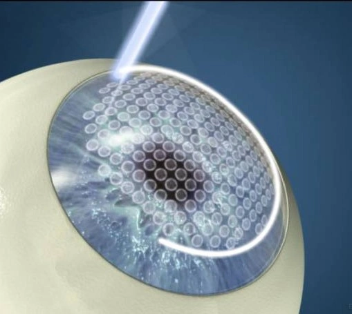 Памятка поможет спокойно подготовиться к LASIK и пройти первые недели после коррекции зрения без лишних рисков.