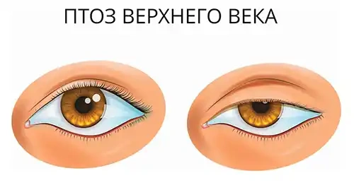 Птоз века: иллюстрация к статье