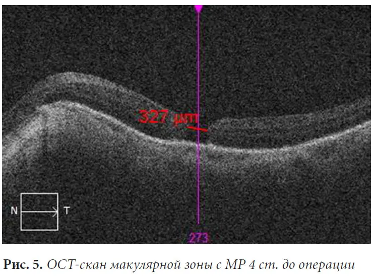 Рис. 5. ОСТ-скан макулярной зоны с МР 4 ст. до операции