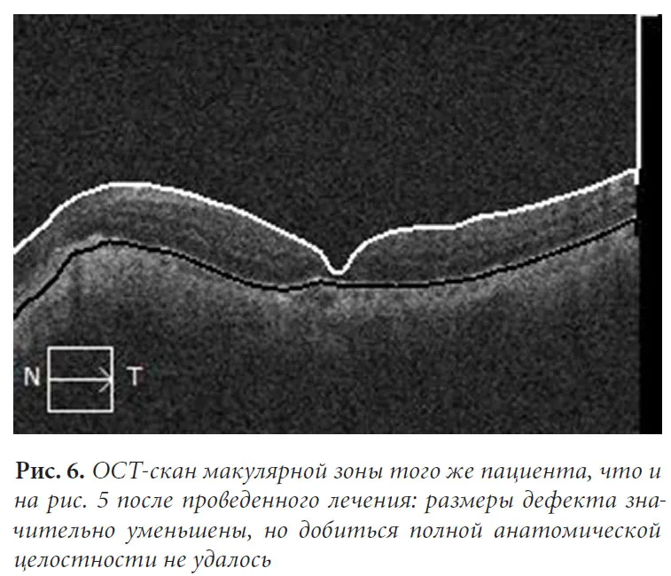 Рис. 6. ОСТ-скан макулярной зоны того же пациента, что и на рис. 5 после проведенного лечения: размеры дефекта значительно уменьшены, но добиться полной анатомической целостности не удалось