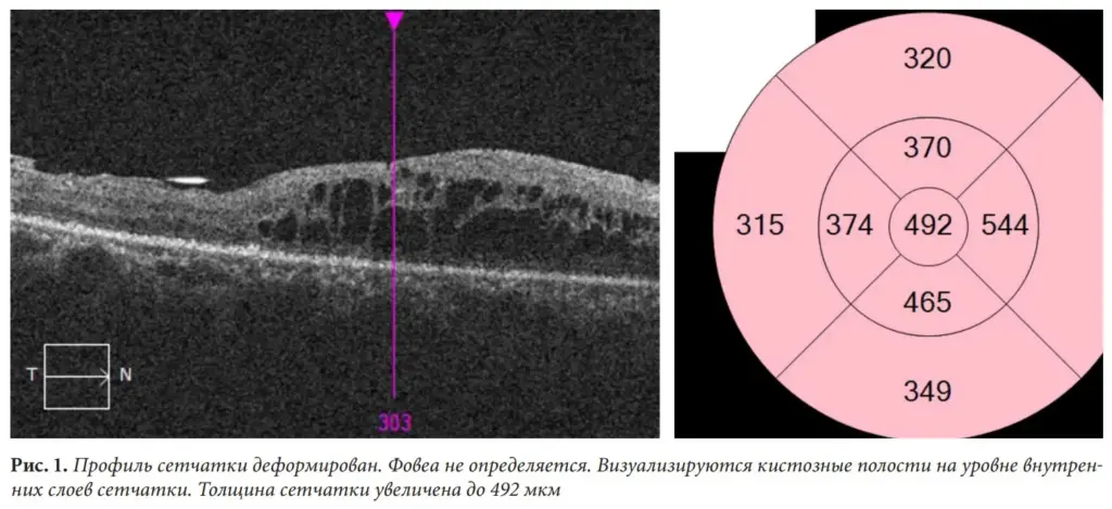 Рис. 1. Профиль сетчатки деформирован. Фовеа не определяется. Визуализируются кистозные полости на уровне внутренних слоев сетчатки. Толщина сетчатки увеличена до 492 мкм