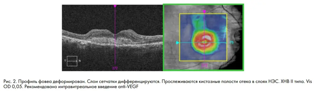 Рис. 2. Профиль фовеа деформирован. Слои сетчатки дифференцируются. Прослеживаются кистозные полости отека в слоях НЭС. ХНВ II типа. Vis OD 0,05. Рекомендовано интравитреальное введение anti-VEGF