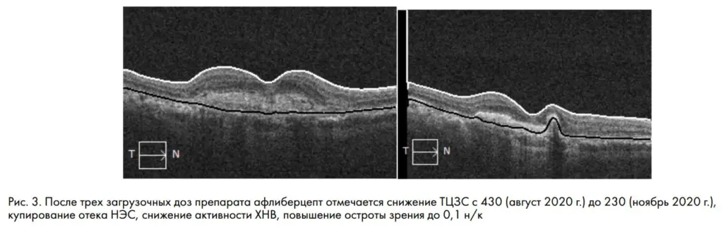 Рис. 3. После трех загрузочных доз препарата афлиберцепт отмечается снижение ТЦЗС с 430 (август 2020 г.) до 230 (ноябрь 2020 г.), купирование отека НЭС, снижение активности ХНВ, повышение остроты зрения до 0,1 н/к