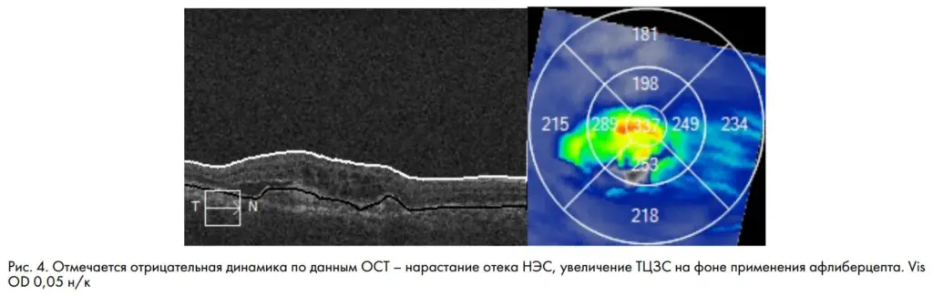 Рис. 4. Отмечается отрицательная динамика по данным ОСТ – нарастание отека НЭС, увеличение ТЦЗС на фоне применения афлиберцепта. Vis OD 0,05 н/к