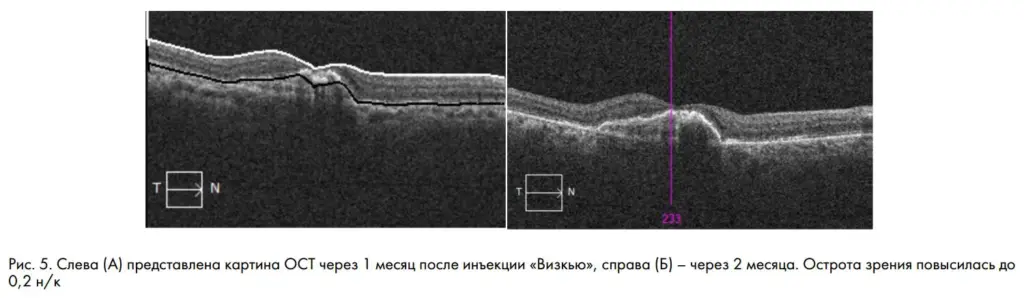 Рис. 5. Слева (А) представлена картина ОСТ через 1 месяц после инъекции «Визкью», справа (Б) – через 2 месяца. Острота зрения повысилась до 0,2 н/к