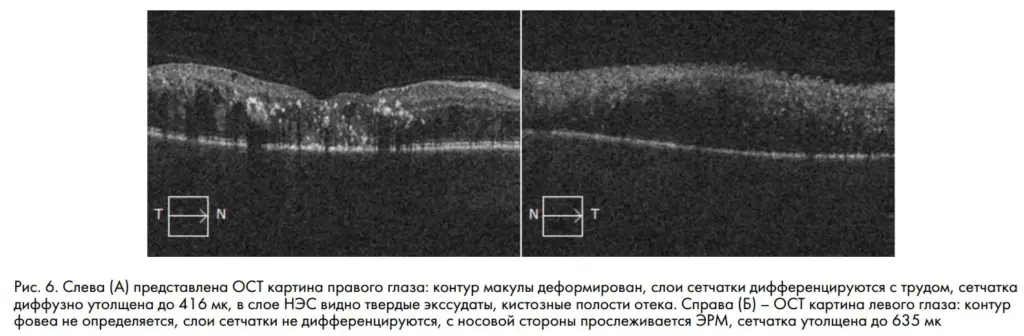 Рис. 6. Слева (А) представлена ОСТ картина правого глаза: контур макулы деформирован, слои сетчатки дифференцируются с трудом, сетчатка диффузно утолщена до 416 мк, в слое НЭС видно твердые экссудаты, кистозные полости отека. Справа (Б) – ОСТ картина левого глаза: контур фовеа не определяется, слои сетчатки не дифференцируются, с носовой стороны прослеживается ЭРМ, сетчатка утолщена до 635 мк