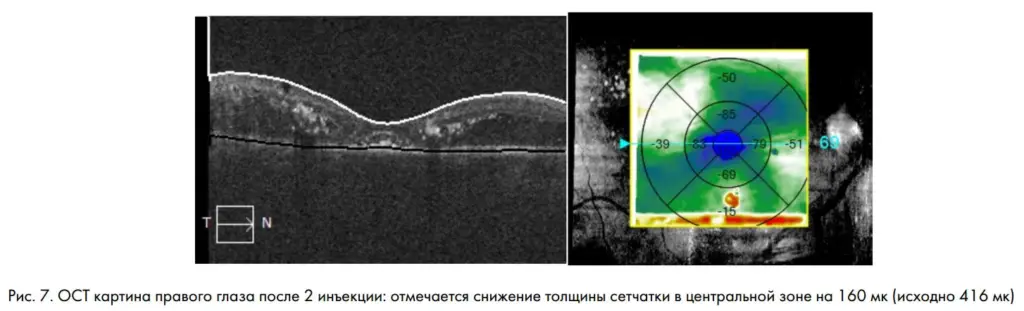 Рис. 7. ОСТ картина правого глаза после 2 инъекции: отмечается снижение толщины сетчатки в центральной зоне на 160 мк (исходно 416 мк)