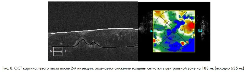 Рис. 8. ОСТ картина левого глаза после 2-й инъекции: отмечается снижение толщины сетчатки в центральной зоне на 183 мк (исходно 635 мк)