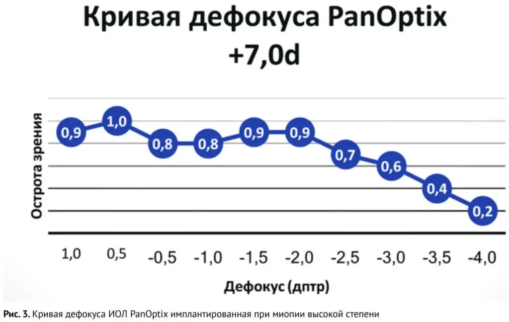 Рис. 3. Кривая дефокуса ИОЛ PanOptix имплантированная при миопии высокой степени